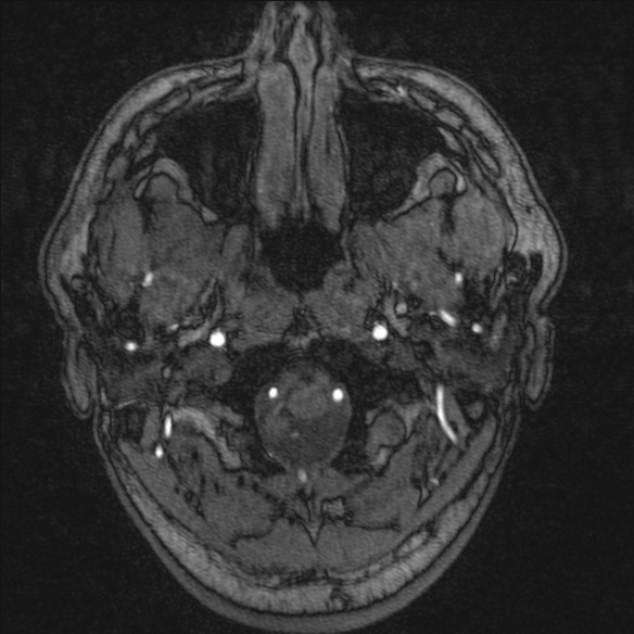 Normal brain MRI including MRA (Radiopaedia 48748-53763 Axial MRA 1).jpg