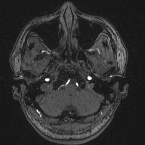 Normal brain MRI including MRA (Radiopaedia 48748-53763 Axial MRA 20).jpg