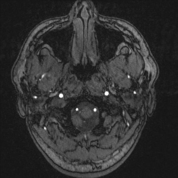 Normal brain MRI including MRA (Radiopaedia 48748-53763 Axial MRA 4).jpg