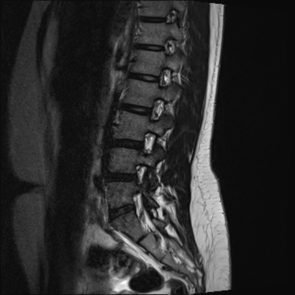 File:Normal lumbar spine MRI- 3 T (Radiopaedia 53280-59250 Sagittal T2 9).jpg