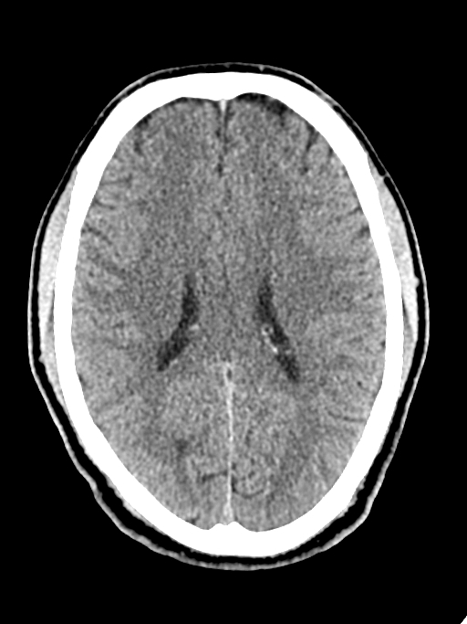 Normal trauma protocol brain and C-spine CT (Radiopaedia 83302-97709 Axial non-contrast 32).jpg