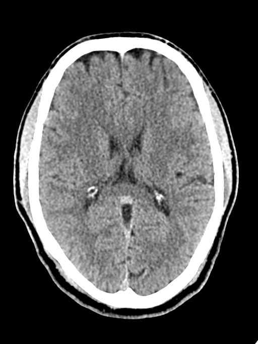 Normal trauma protocol brain and C-spine CT (Radiopaedia 83302-97709 Axial non-contrast 35).jpg