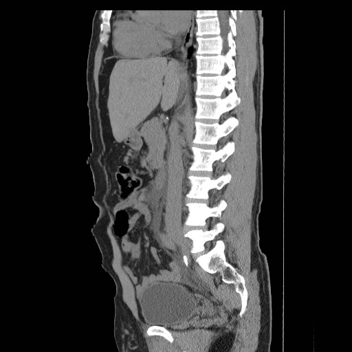File:Obstructed kidney with perinephric urinoma (Radiopaedia 26889-27066 B 28).jpg