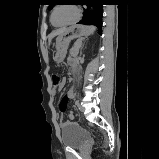 File:Obstructed kidney with perinephric urinoma (Radiopaedia 26889-27066 B 42).jpg