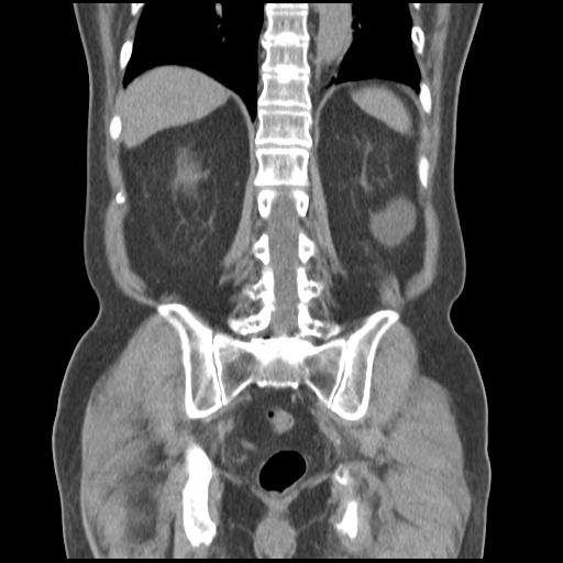 Obstructing renal calculus (Radiopaedia 29517-30016 Coronal non-contrast 40).jpg