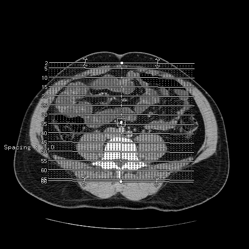 File:Obstructing ureteric calculus (Radiopaedia 18615-18514 C 1).jpg