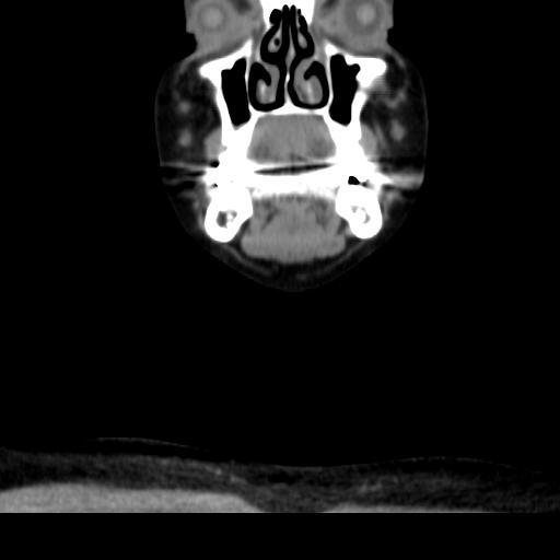 File:Obstructive sleep apnea (CT evaluation) (Radiopaedia 24304-24582 Coronal non-contrast 25).jpg