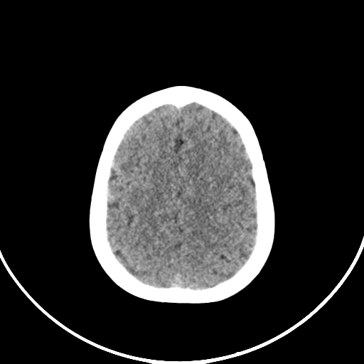 Occipital encephalocele (Radiopaedia 87339-103636 Axial non-contrast 68).jpg