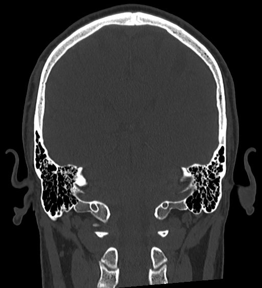 Occipital spur and Currarino type A atlas anomaly (Radiopaedia 87027-103285 Coronal bone window 98).jpg