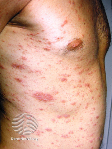 File:Pityriasis rosea (DermNet NZ viral-pityriasis-rosea-09).jpg