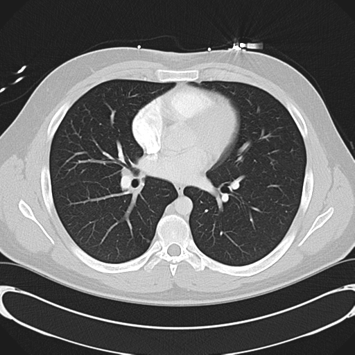 File:'Bovine' aortic arch (Radiopaedia 33554-34637 Axial lung window 33).png