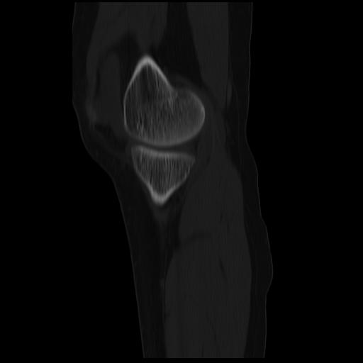File:ACL avulsion fracture (Radiopaedia 33833-34994 Sagittal bone window 33).jpg