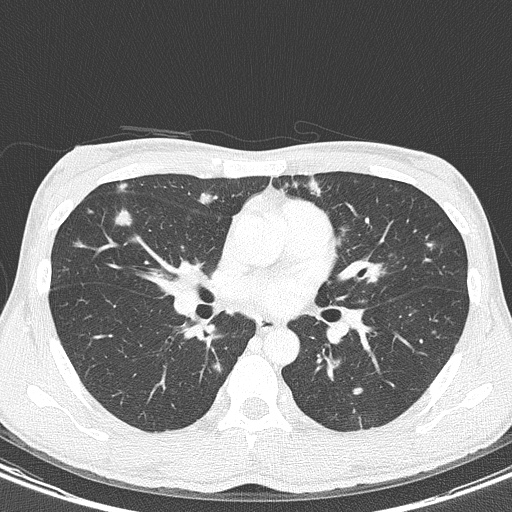 AIDS-related Kaposi sarcoma (Radiopaedia 85247-100811 Axial lung window 84).jpg