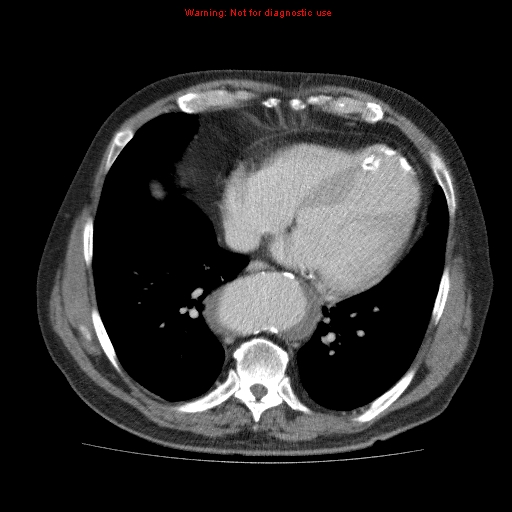 Abdominal aortic aneurysm (Radiopaedia 10122-10660 Axial C+ portal venous phase 2).jpg