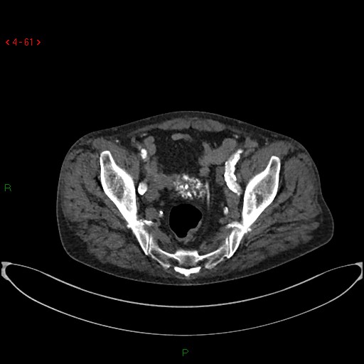 File:Abdominal aortic aneurysm (Radiopaedia 16155-15834 Axial C+ arterial phase 41).jpg