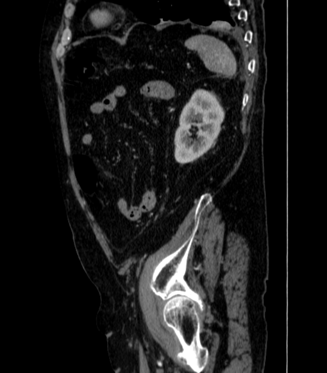 Abdominal aortic aneurysm (Radiopaedia 25855-26001 Sagittal C+ arterial phase 68).jpg