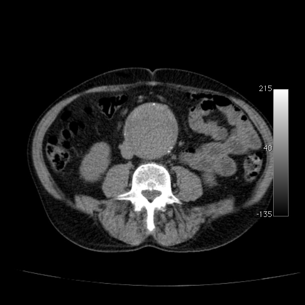 Abdominal aortic aneurysm (Radiopaedia 29248-29660 Axial non-contrast 32).jpg