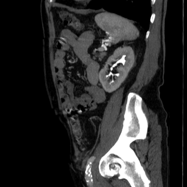 Abdominal aortic aneurysm (Radiopaedia 29248-29660 Sagittal C+ arterial phase 41).jpg