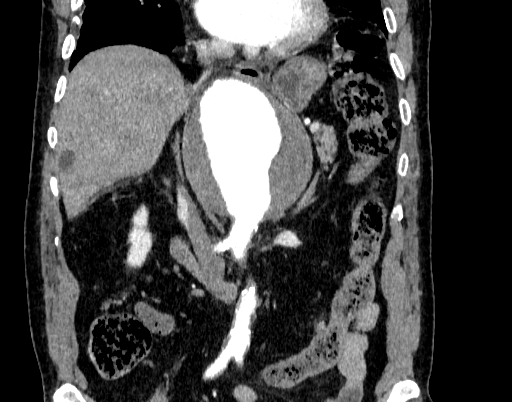 File:Abdominal aortic aneurysm (Radiopaedia 67117-76452 Coronal C+ arterial phase 45).jpg