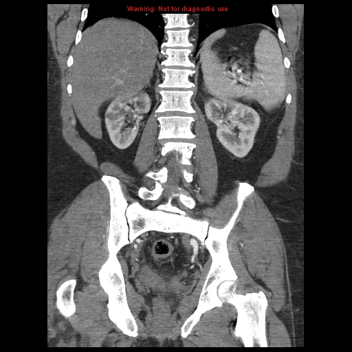 Abdominal aortic aneurysm (Radiopaedia 8190-9038 Coronal C+ arterial phase 88).jpg