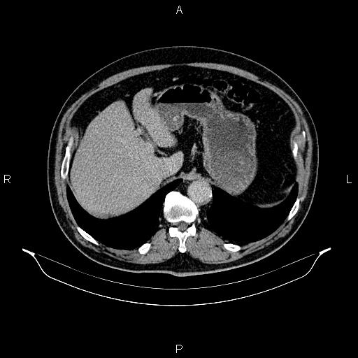 Abdominal aortic aneurysm (Radiopaedia 83094-97462 Axial renal excretory phase 26).jpg