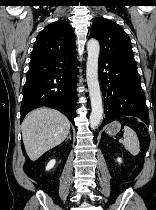 Abdominal aortic aneurysm (Radiopaedia 83094-97462 Coronal renal cortical phase 63).jpg