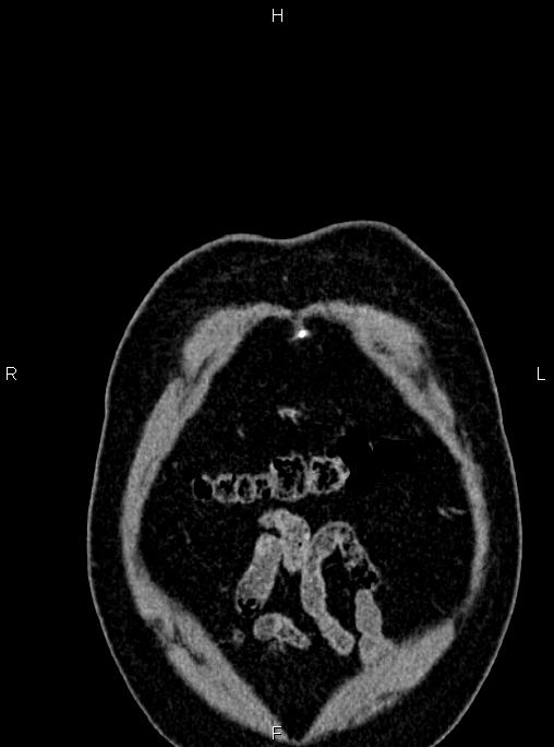 Abdominal aortic aneurysm (Radiopaedia 83094-97462 Coronal renal cortical phase 9).jpg