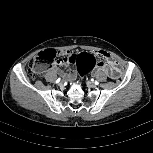 Abdominal aortic aneurysm (Radiopaedia 83581-98689 Axial C+ arterial phase 88).jpg