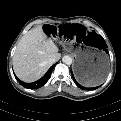 Abdominal aortic aneurysm (Radiopaedia 83581-98689 Axial C+ portal venous phase 19).jpg