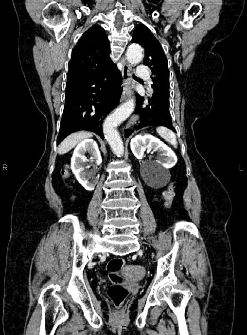 Abdominal aortic aneurysm (Radiopaedia 85063-100606 Coronal C+ arterial phase 38).jpg