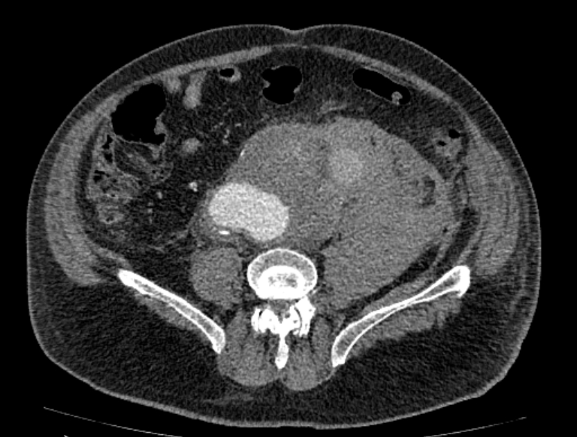 Abdominal aortic aneurysm rupture (Radiopaedia 54179-60362 Axial C+ arterial phase 40).jpg