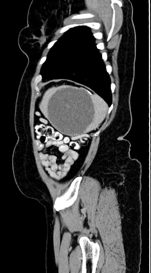 Abdominal hydatid disease (Radiopaedia 68223-77737 Sagittal C+ portal venous phase 9).jpg