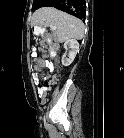 Abdominal lymphoma with sandwich sign (Radiopaedia 84378-99704 Sagittal C+ portal venous phase 23).jpg