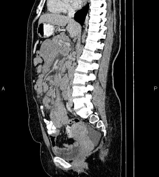Abdominal lymphoma with sandwich sign (Radiopaedia 84378-99704 Sagittal C+ portal venous phase 42).jpg
