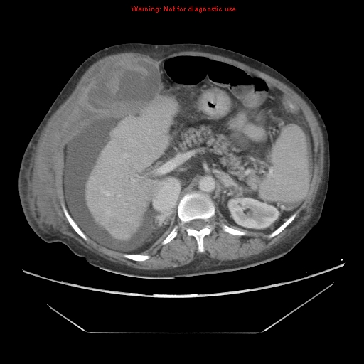 File:Abdominal wall hematoma (Radiopaedia 9427-10112 Axial C+ portal venous phase 35).jpg