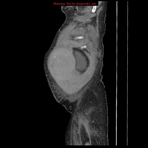 Abdominal wall hematoma (Radiopaedia 9427-10112 Sagittal C+ portal venous phase 102).jpg
