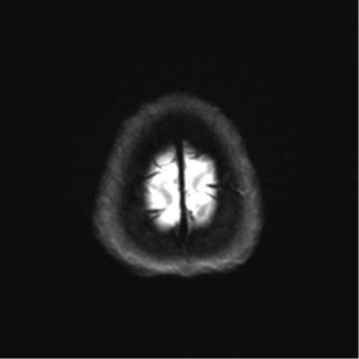 File:Abducens nerve palsy (Radiopaedia 51069-56648 Axial DWI 26).png