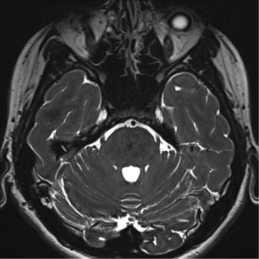 File:Abducens nerve palsy (Radiopaedia 51069-56648 Axial T2 fat sat 35).png
