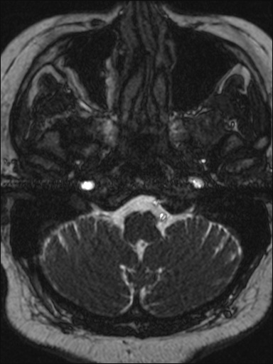 File:Abducens nerve palsy (Radiopaedia 57084-63976 Axial T2 ciss 3d 9).jpg