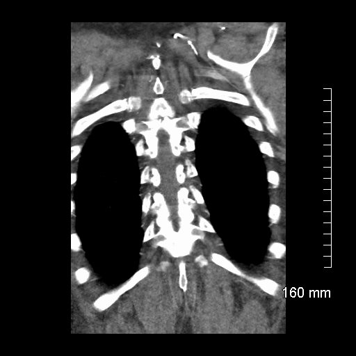 Aberrant right subclavian artery stenosis (Radiopaedia 52656-58670 B 73).jpg