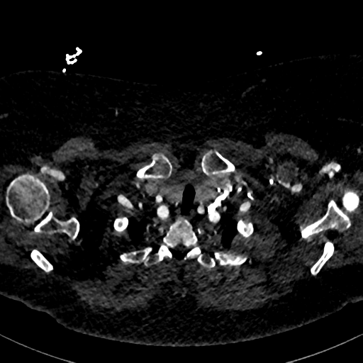 Aberrant right subclavian artery with Kommerell diverticulum (Radiopaedia 47982-52769 Axial C+ arterial phase 10).png