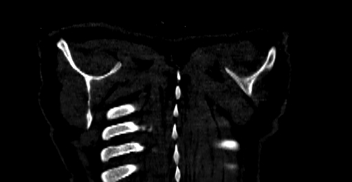 Accesory rib joint (Radiopaedia 71987-82452 Coronal bone window 91).jpg