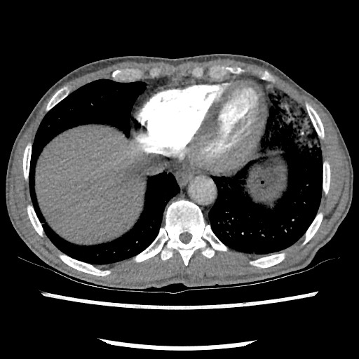 Accessory left horizontal fissure with lingular pneumonia (Radiopaedia 53763-59843 Axial C+ CTPA 72).jpg