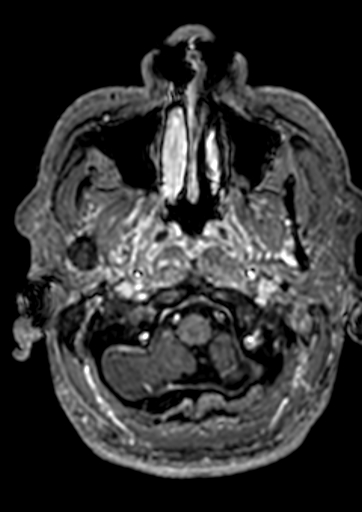 Accessory middle cerebral artery (Radiopaedia 73114-83828 Axial T1 C+ 179).jpg
