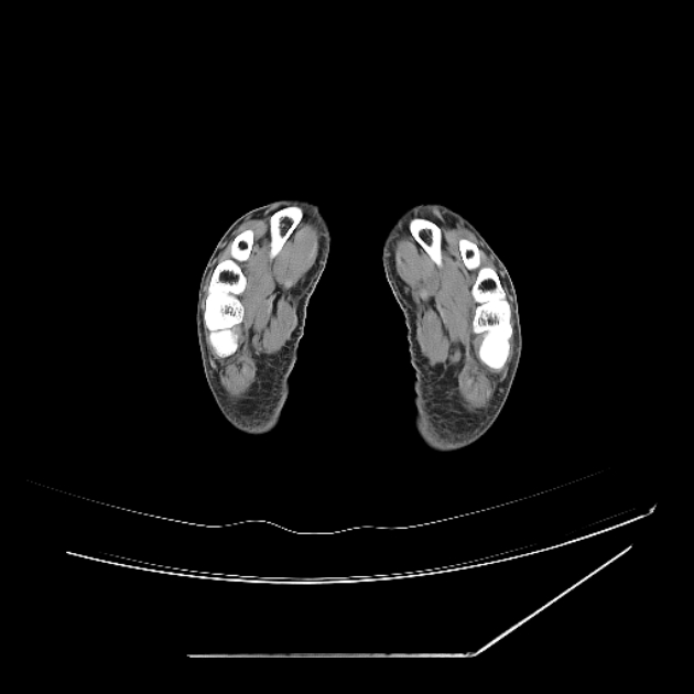 Accessory soleus muscle (Radiopaedia 61069-68943 Axial non-contrast 84).jpg