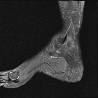 File:Achilles tendon tear (Radiopaedia 77615-89819 Sagittal PD fat sat 3).jpg