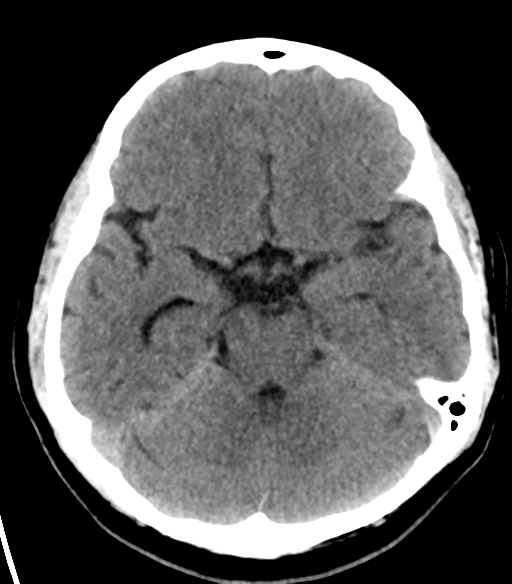 File:Acoustic schwannoma (Radiopaedia 33045-34065 Axial non-contrast 9).png
