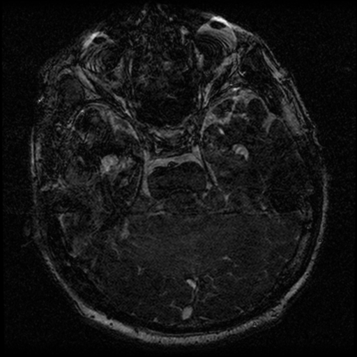 File:Acoustic schwannoma (Radiopaedia 39170-41387 Axial FIESTA 102).png