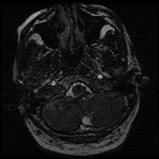 File:Acoustic schwannoma (Radiopaedia 39170-41387 Axial FIESTA 24).png