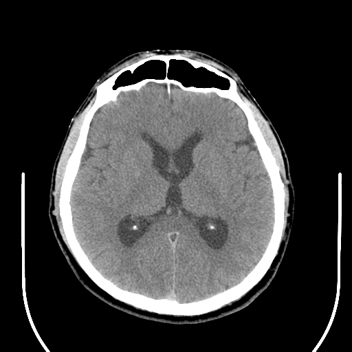 File:Acoustic schwannoma (Radiopaedia 39170-41388 Axial non-contrast 26).png